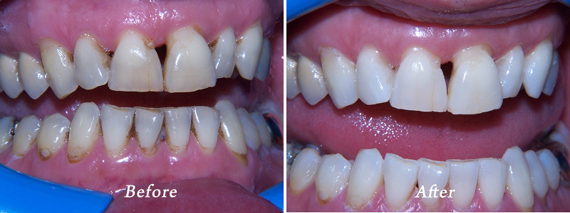 POLANIGHT TEETH WHITENING. POLANIGHT TEETH