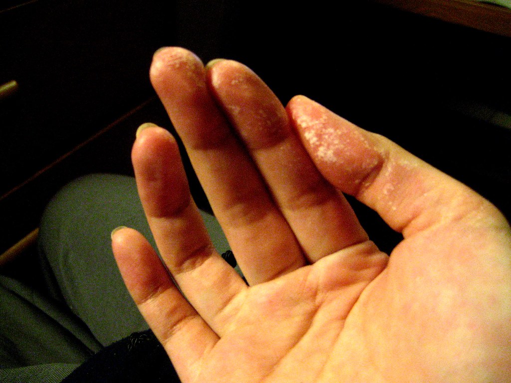 HYDROGEN PEROXIDE AND ACNE