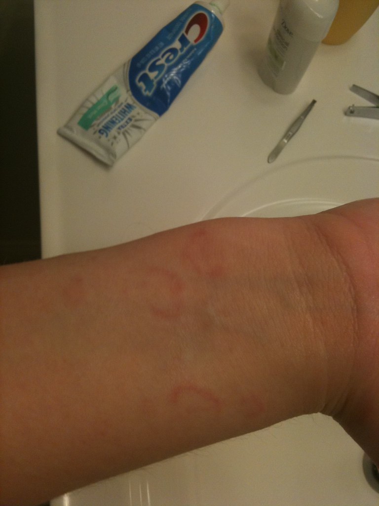 SYMPTOMS OF RINGWORM IN HUMANS SYMPTOMS OF RINGWORM 3 MONTHS