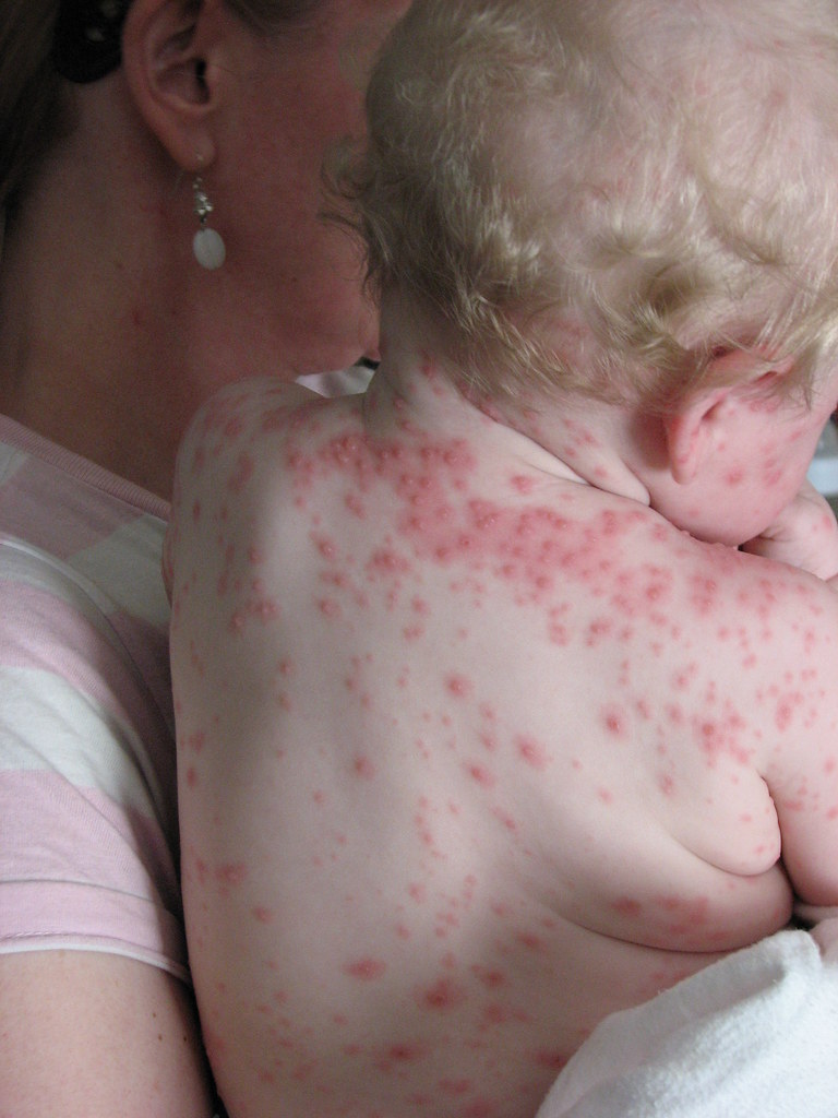 CHICKEN POX SYMPTOMS IN CHILDREN. SYMPTOMS IN CHILDREN CHICKEN POX