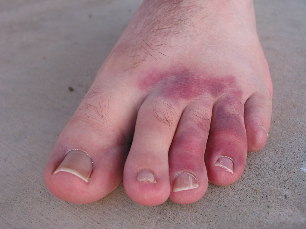 KNEE PAIN NO SWELLING NO SWELLING Knee pain no swelling Neck