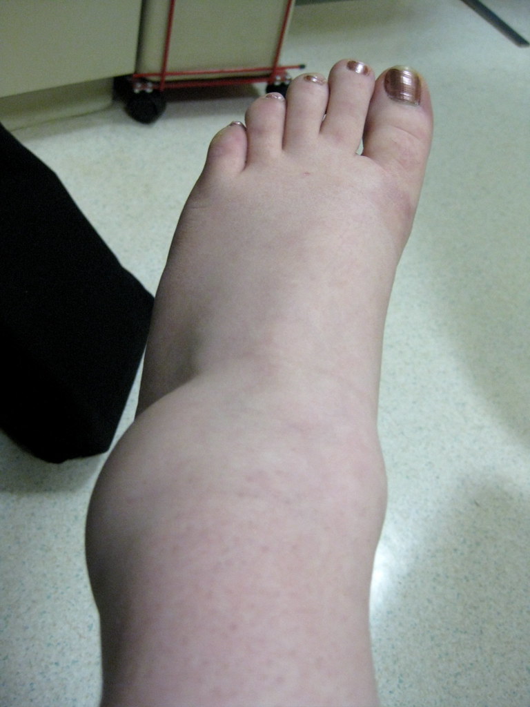 Swollen Foot Pain INNER ANKLE PAIN