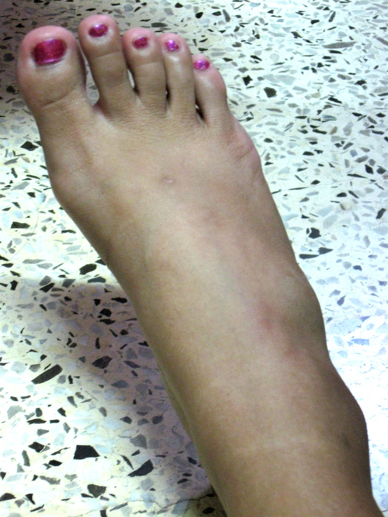 Pain In Ankle Bone INNER ANKLE PAIN