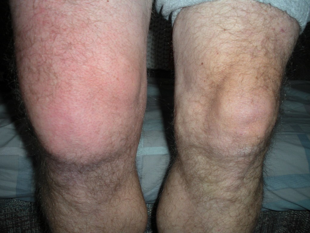 KNEE SWELLING NO PAIN KNEE SWELLING Knee swelling no pain Sinus