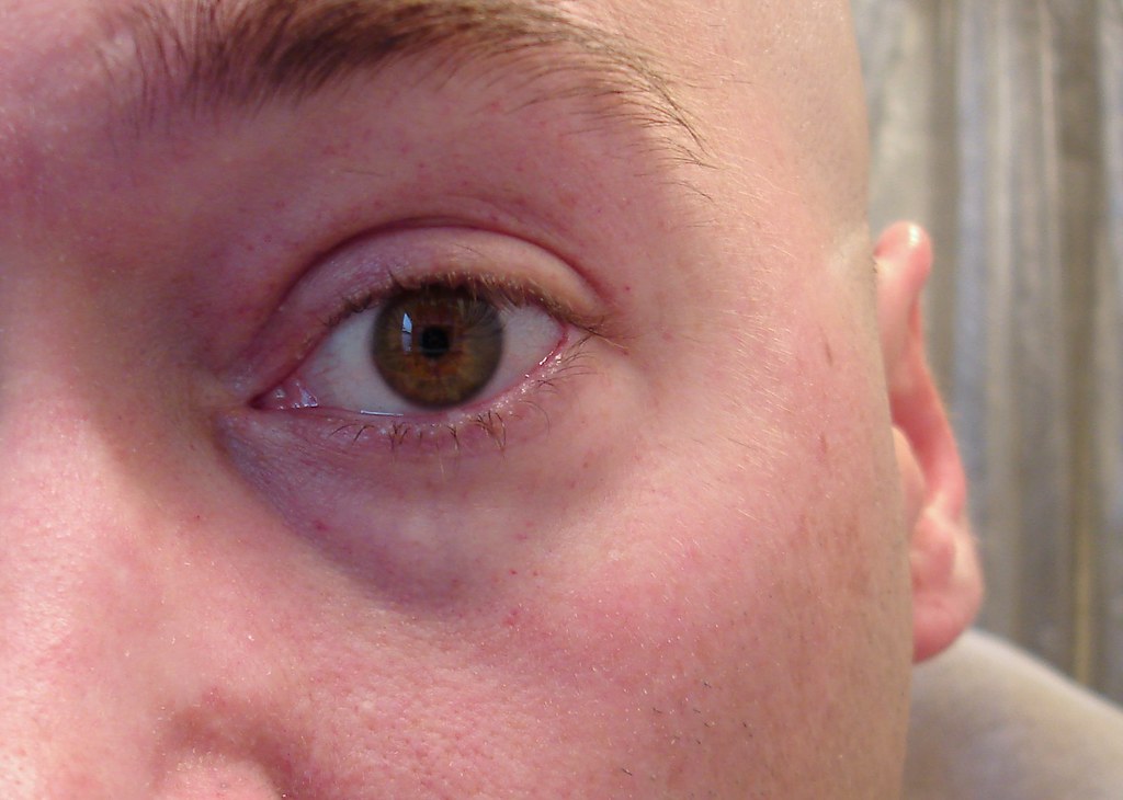 POPPED BLOOD VESSEL IN EYE POPPED BLOOD VESSEL IN EYE