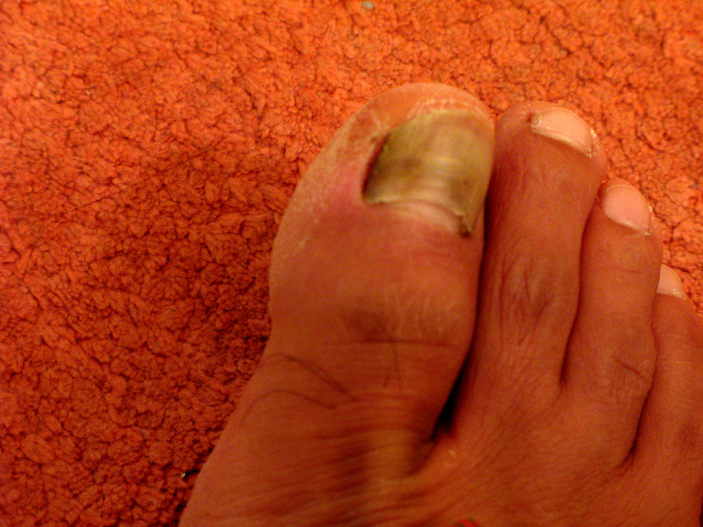 Toe Nail Infection RECURRING BLADDER INFECTIONS