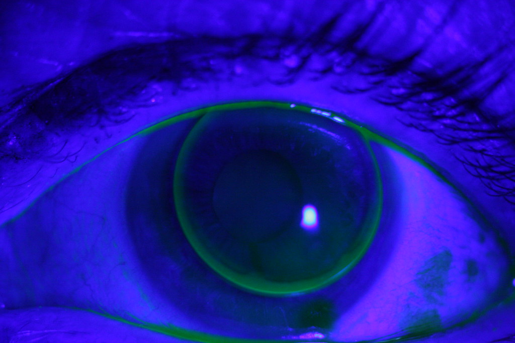 GAS PERMEABLE CONTACT LENSES CLEANING GAS PERMEABLE CONTACT Gas