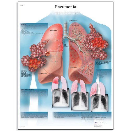 PNEUMONIA IN BABIES SYMPTOMS PNEUMONIA IN 6 WEEK OLD BREASTFED BABY