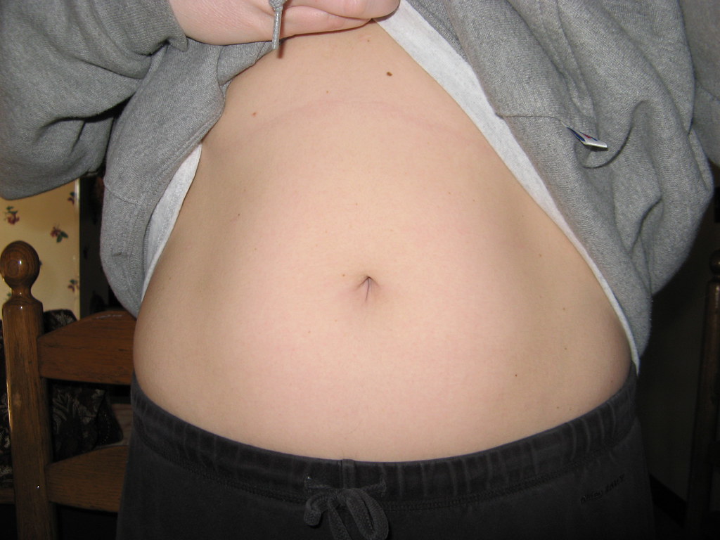 BELLY BUTTON HERNIA REPAIR BELLY BUTTON AMERICAN STANDARD TOILETS