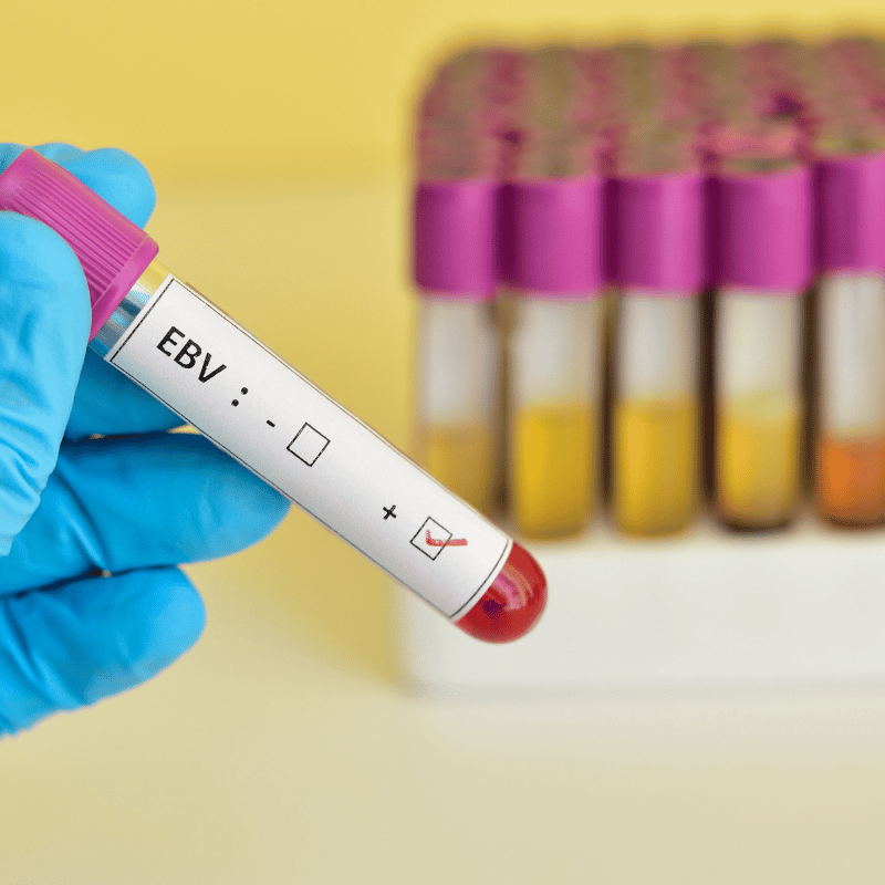 EpsteinBarr Virus (EBV) Acute Infection Antibodies Profile Blood Test