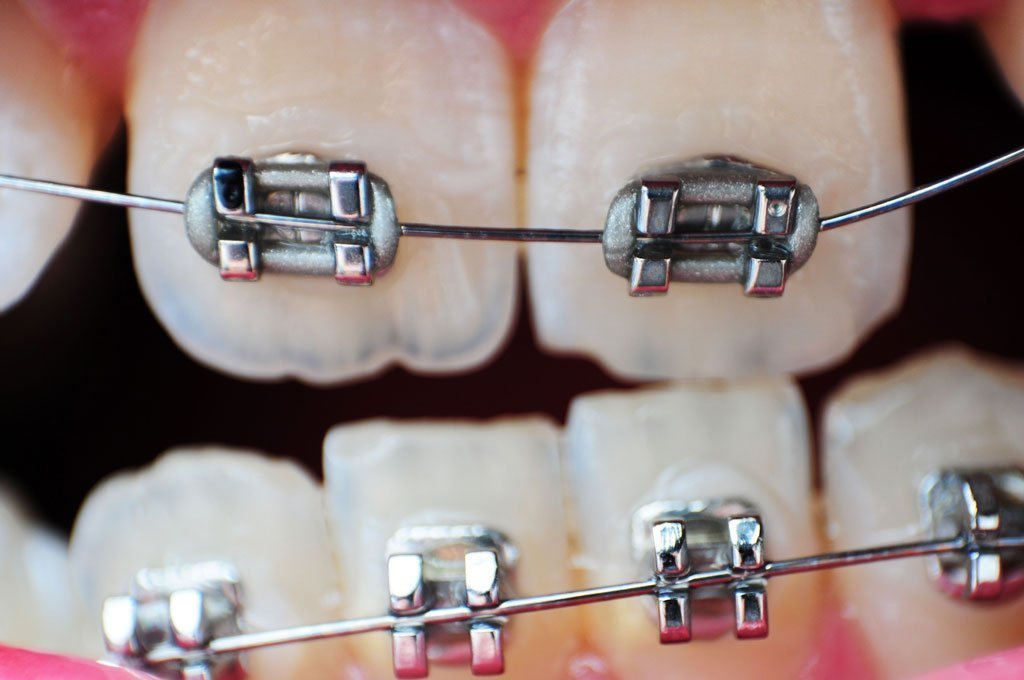 Braces may straighten teeth but they don’t stop decay