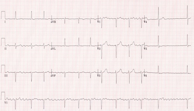 Risk of mortality and cardiovascular among