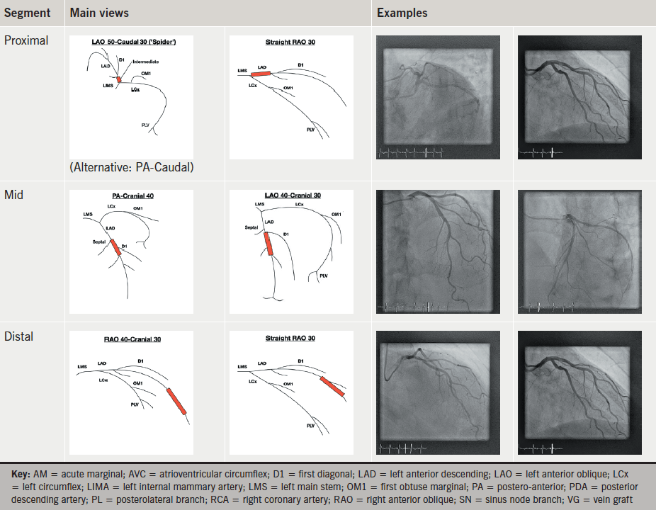 Optimal angiographic views for invasive coronary angiography a guide for trainees The British
