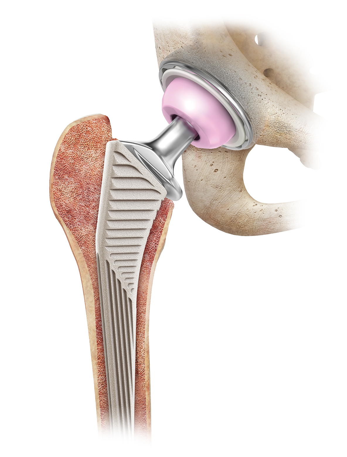 Total Hip Replacement BJISG