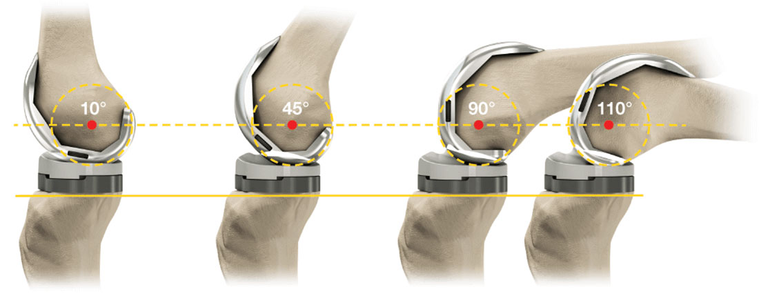 Total Knee Replacement: Process, Recovery and Results