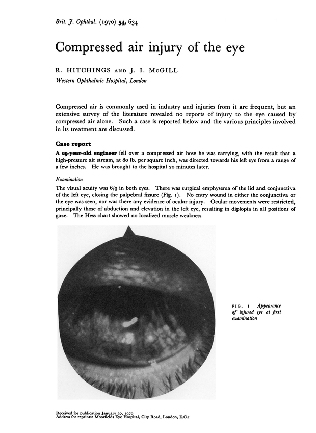 Compressed air injury of the eye. British Journal of Ophthalmology