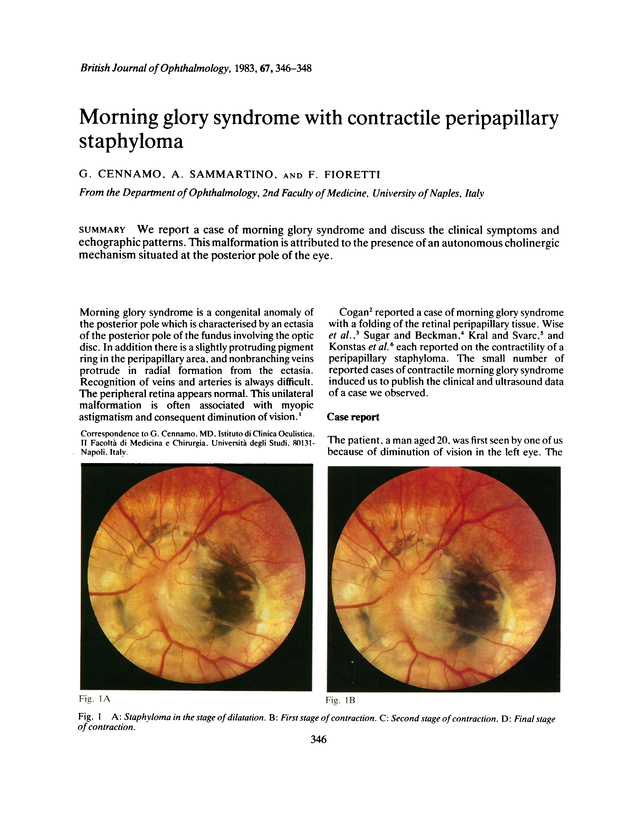 Morning glory syndrome with contractile peripapillary staphyloma