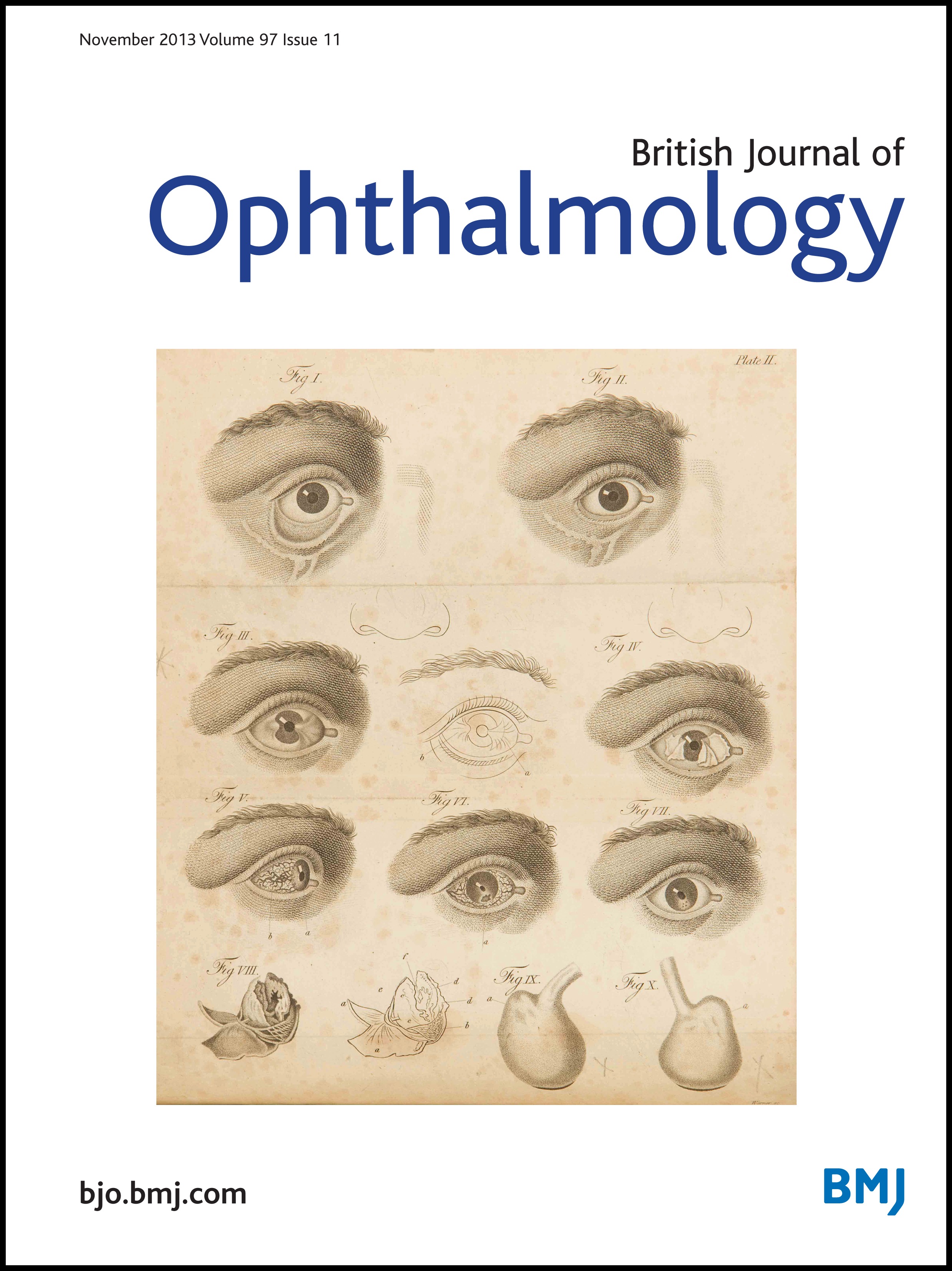 Distance esotropia in the elderly British Journal of Ophthalmology