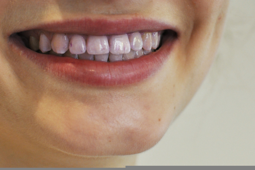 Red Wine And Your Teeth What You Need To Know