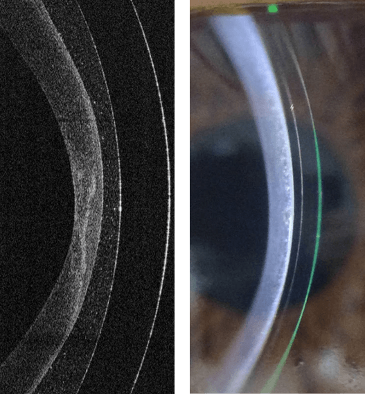 Optimizing Ocular Health with Onefit Scleral Lenses