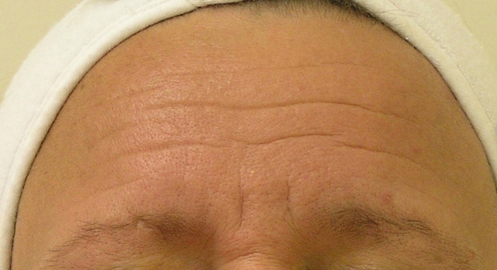 Hydrafacial Near Me Hydrafacial Skin Treatment Palm Harbor