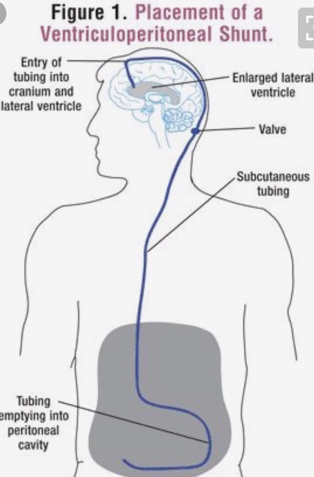 I mostly hate my shunt Blissful Brain