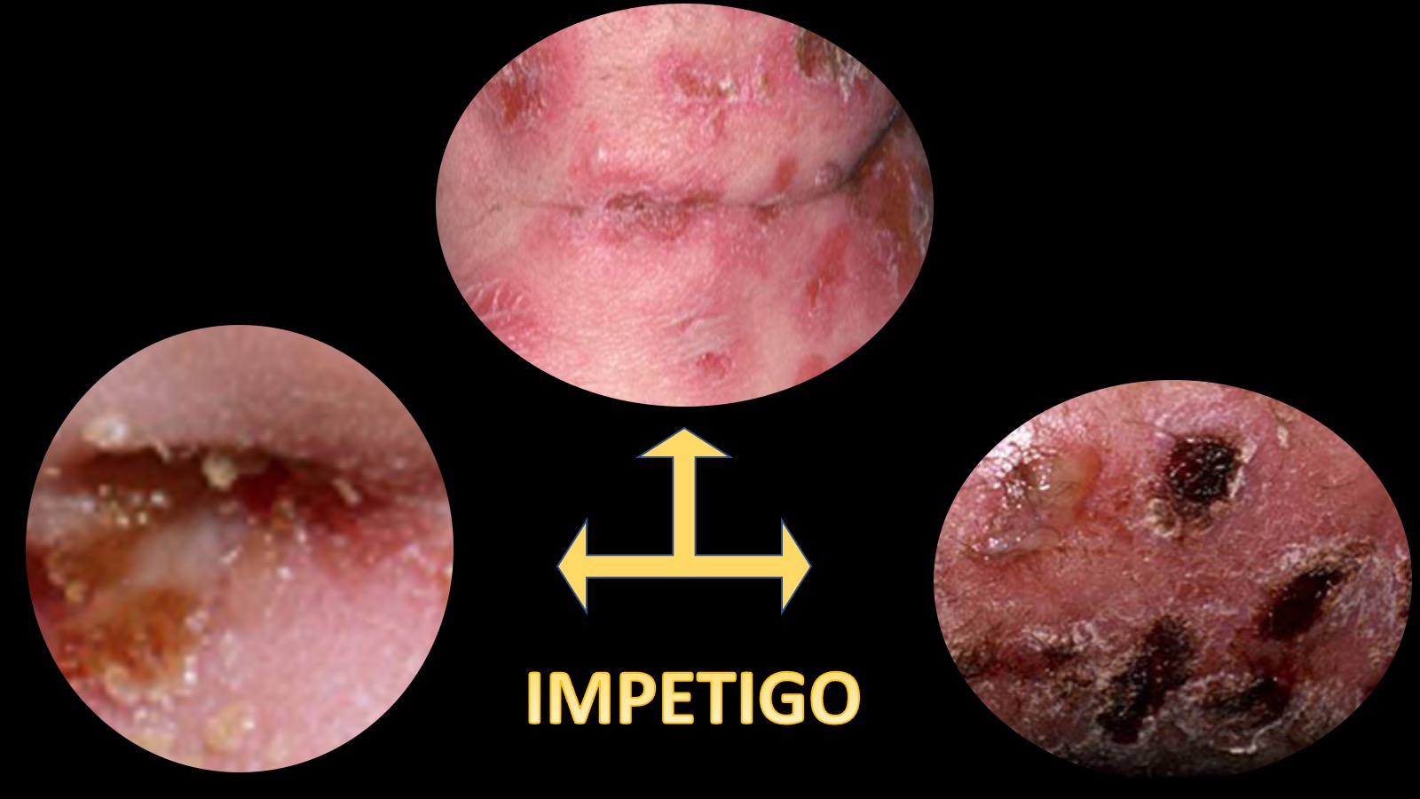 Treatment of Impetigo Pediatric Practice… Pearls for your Pediatric