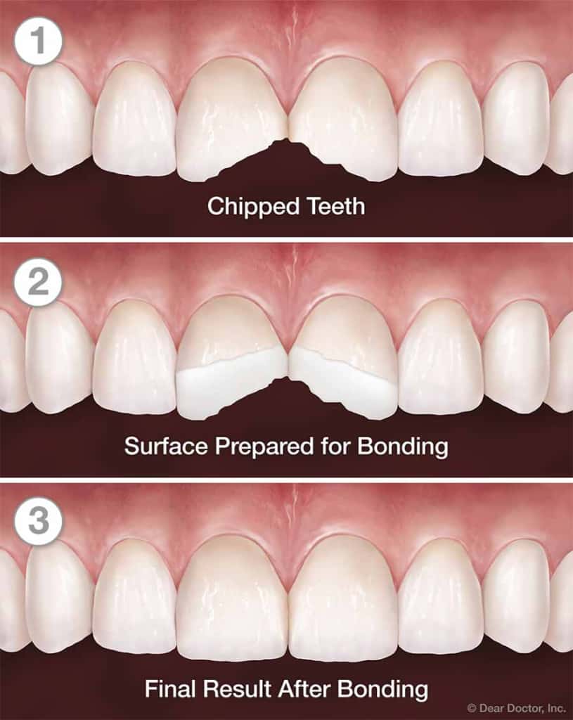 Tooth bonding 101 How it works, how much is costs, and what to expect
