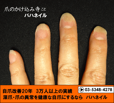 爪が離れる症状 自爪矯正の変化画像 病院で治らなかった爪の病気も健康的な爪に治すブログ