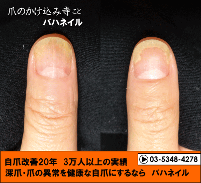 爪が離れる症状 自爪矯正の変化画像 病院で治らなかった爪の病気も健康的な爪に治すブログ