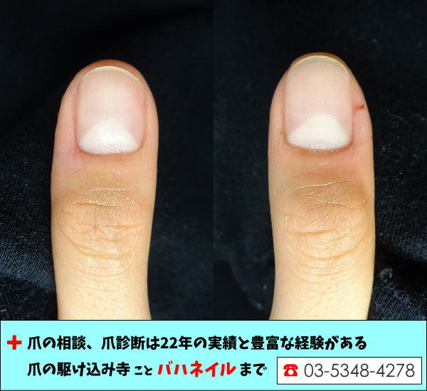 指先の乾燥で爪が凹む 病院で治らなかった爪の病気も健康的な爪に治すブログ