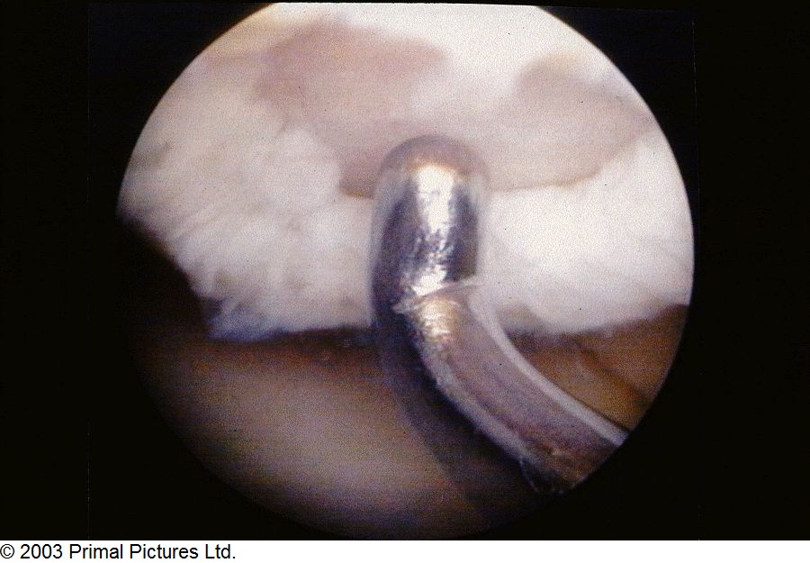 Arthritis as related to Chondromalacia patella Pictures