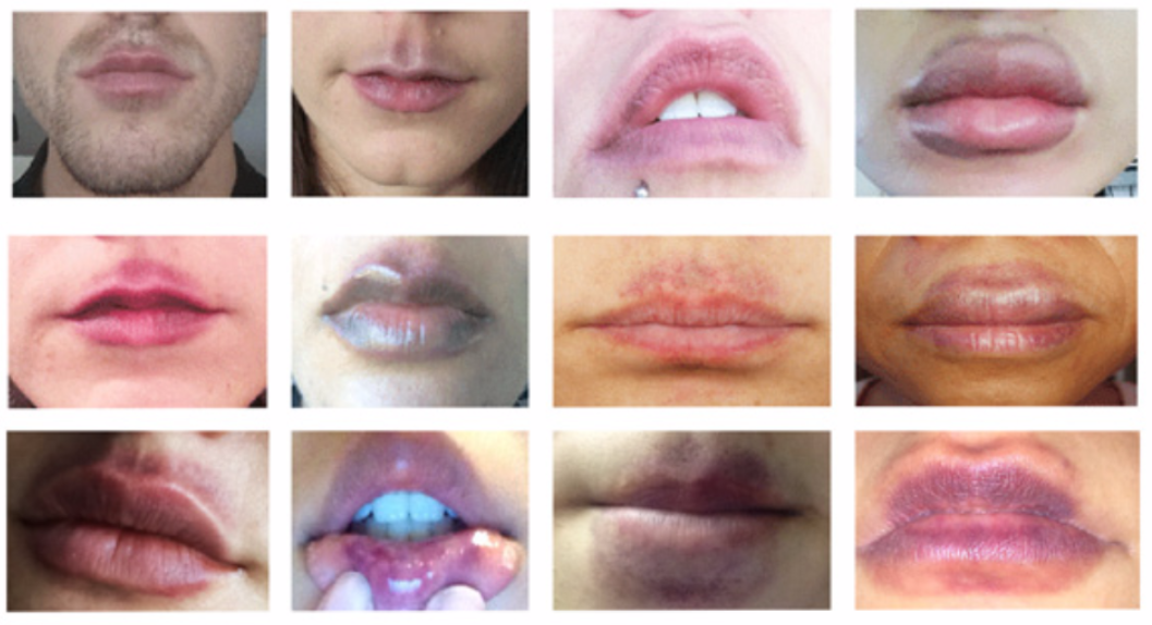 Cupping Marks, Are They Bruises? A Scientific Review