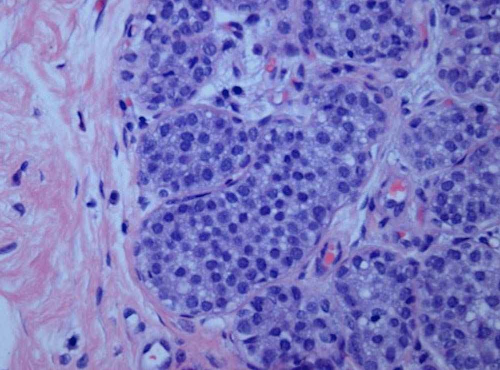 What Is Lobular Breast Cancer? DanaFarber Cancer Institute