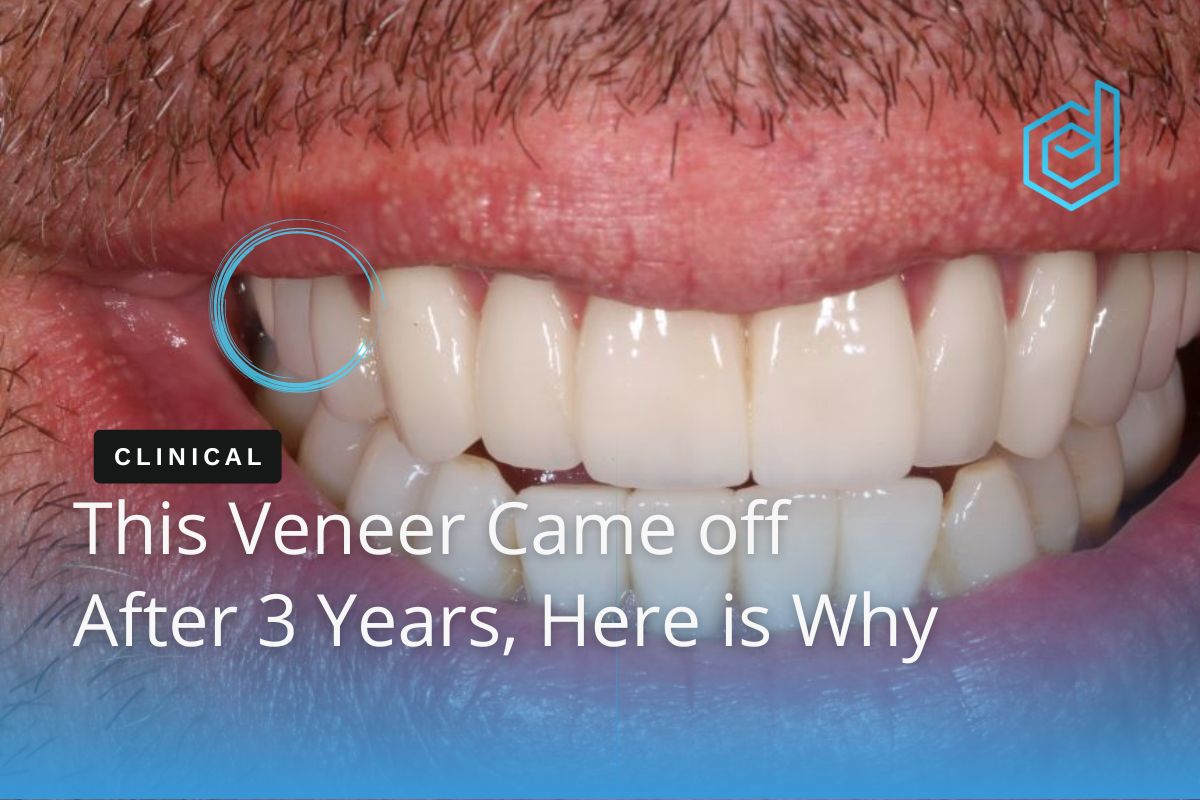 This Veneer came off after 3 years... Here is the reason
