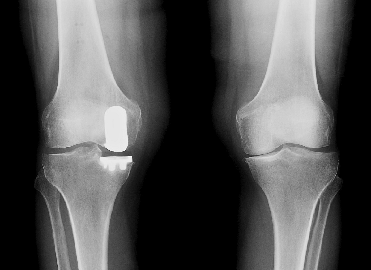 Revision Total Knee Replacement docOPD