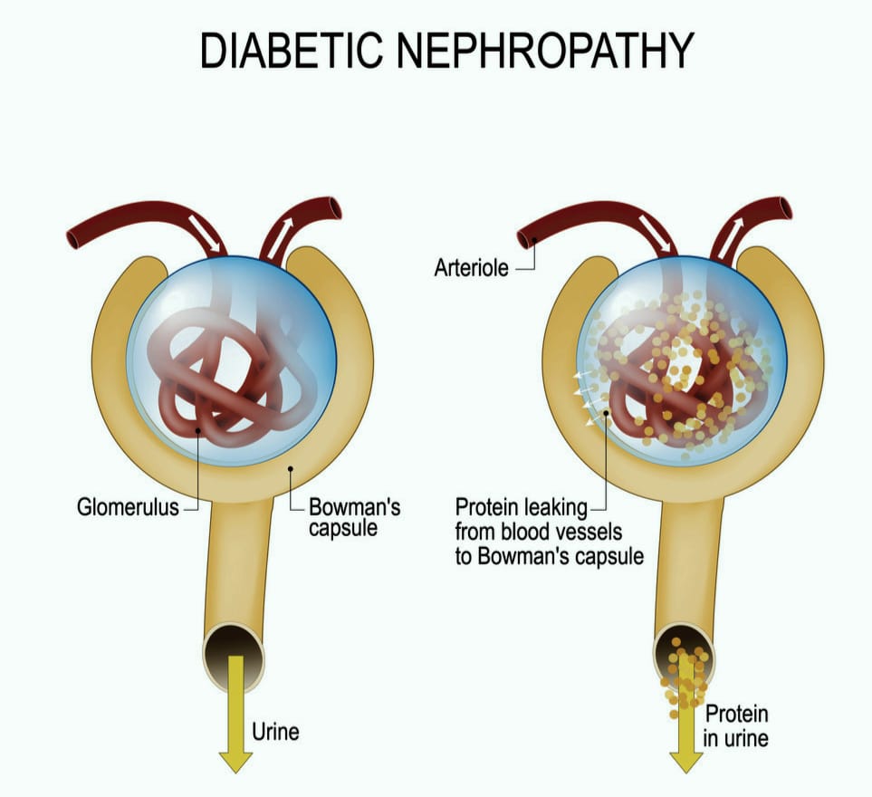 Diabetic Nephropathy Histology