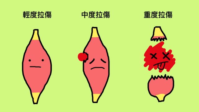 好痛痛-肌肉拉傷-輕度拉傷-中度拉傷-重度拉傷-肌肉拉傷-運動傷害-疼痛-運動受傷