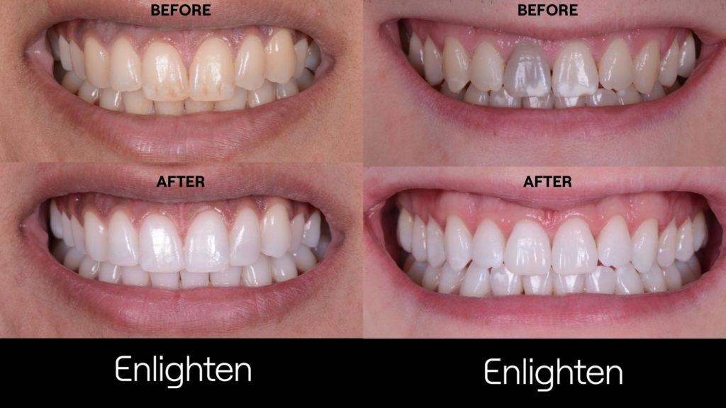 FAQ's on Enlighten Whitening Patient