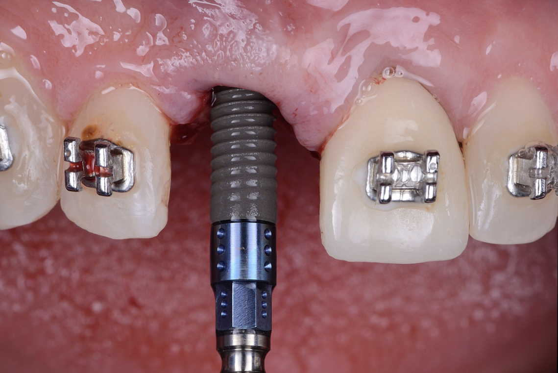 Guidelines for ridge preservation when and how ITI Blog