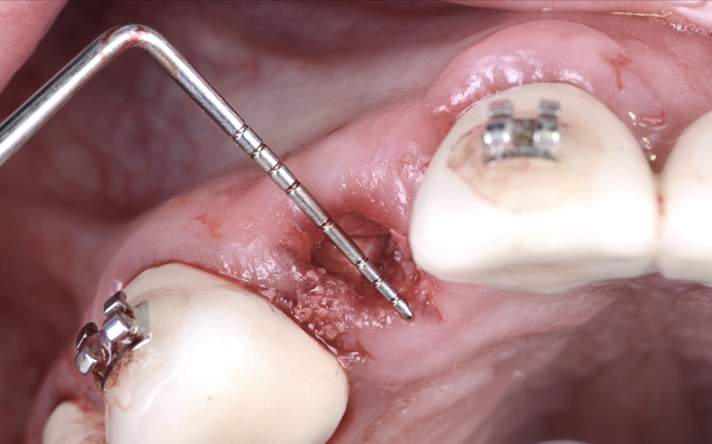 ridge preservation Archives ITI Blog