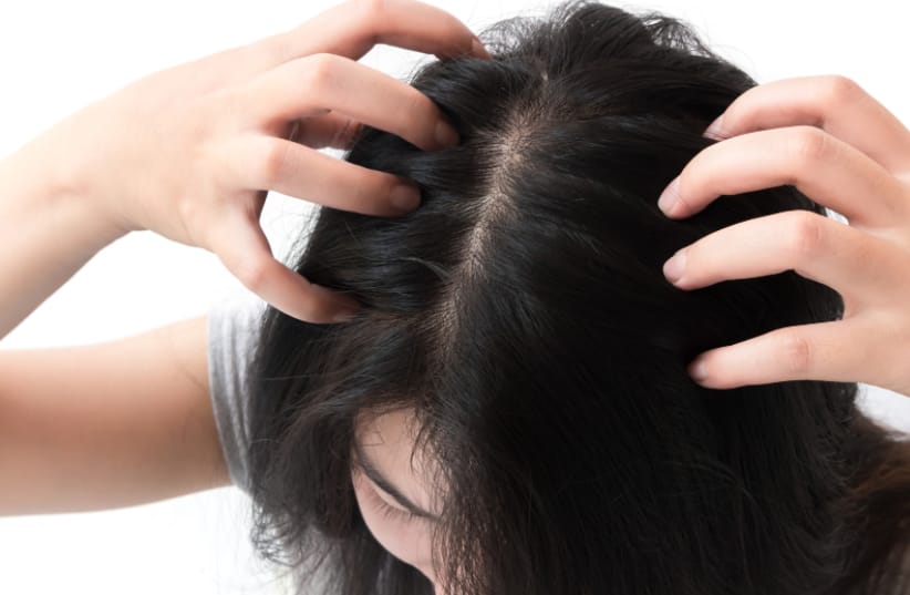 Top 6 dry and itchy scalp remedies at home! Iyurved