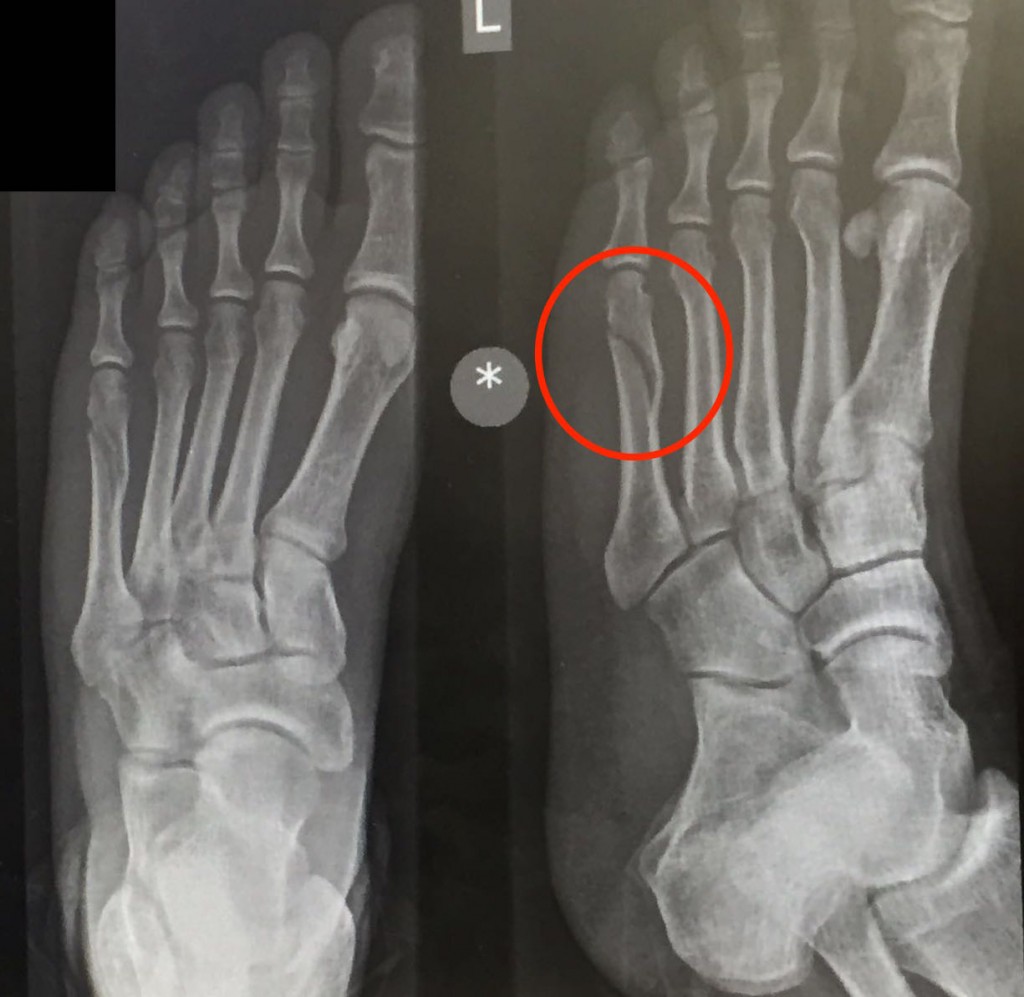 How To Tell If You Fractured Your Metatarsal at Herbert Wilburn blog