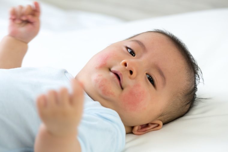My baby has red spots on their face what should I do? Kinedu Blog