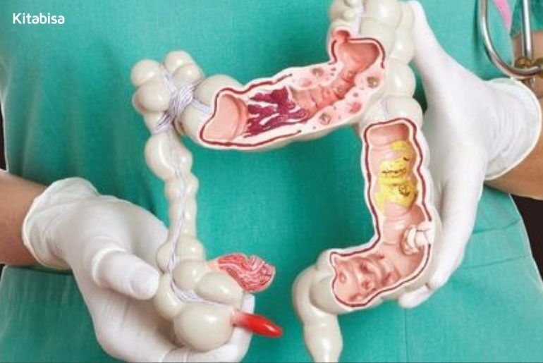 Tandatanda Kanker Usus Besar yang Dialami Puput