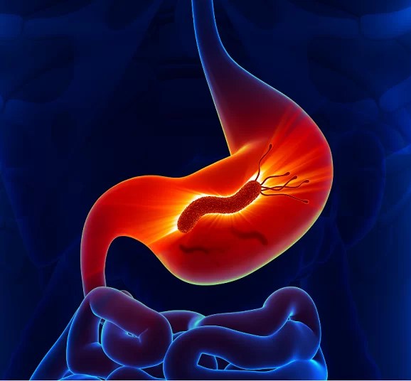 What causes Stomach Ulcer Signs and Treatments for Gastric Ulcer