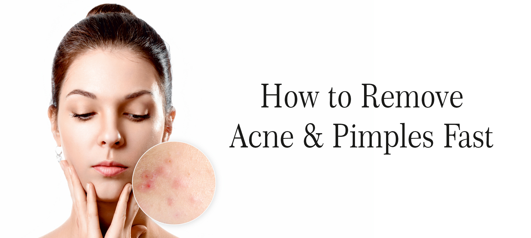 How to Remove Acne & Pimples Fast MedPlusMart