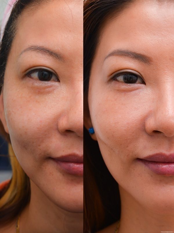 MicroDysport at Halley Medical Aesthetics The Moonberry Blog