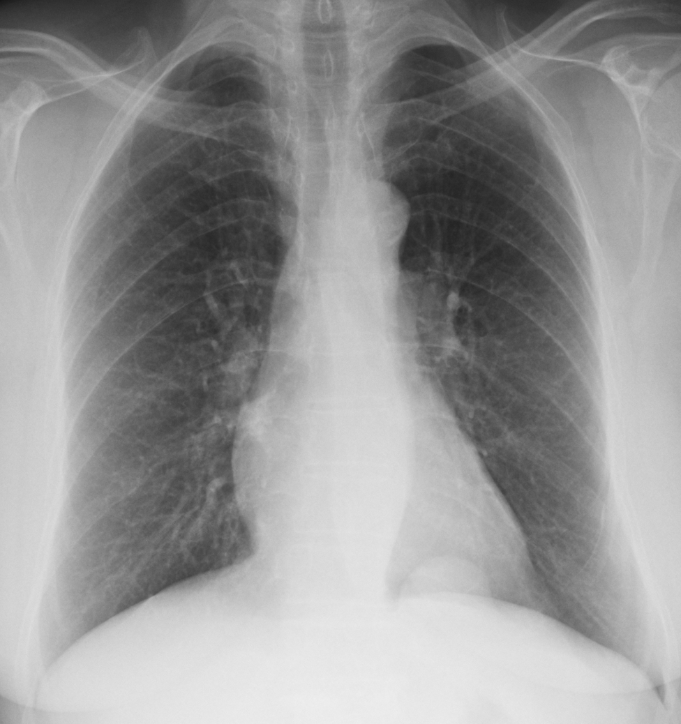 Cáceres’ Corner Case 217 SOLVED European Diploma of Radiology