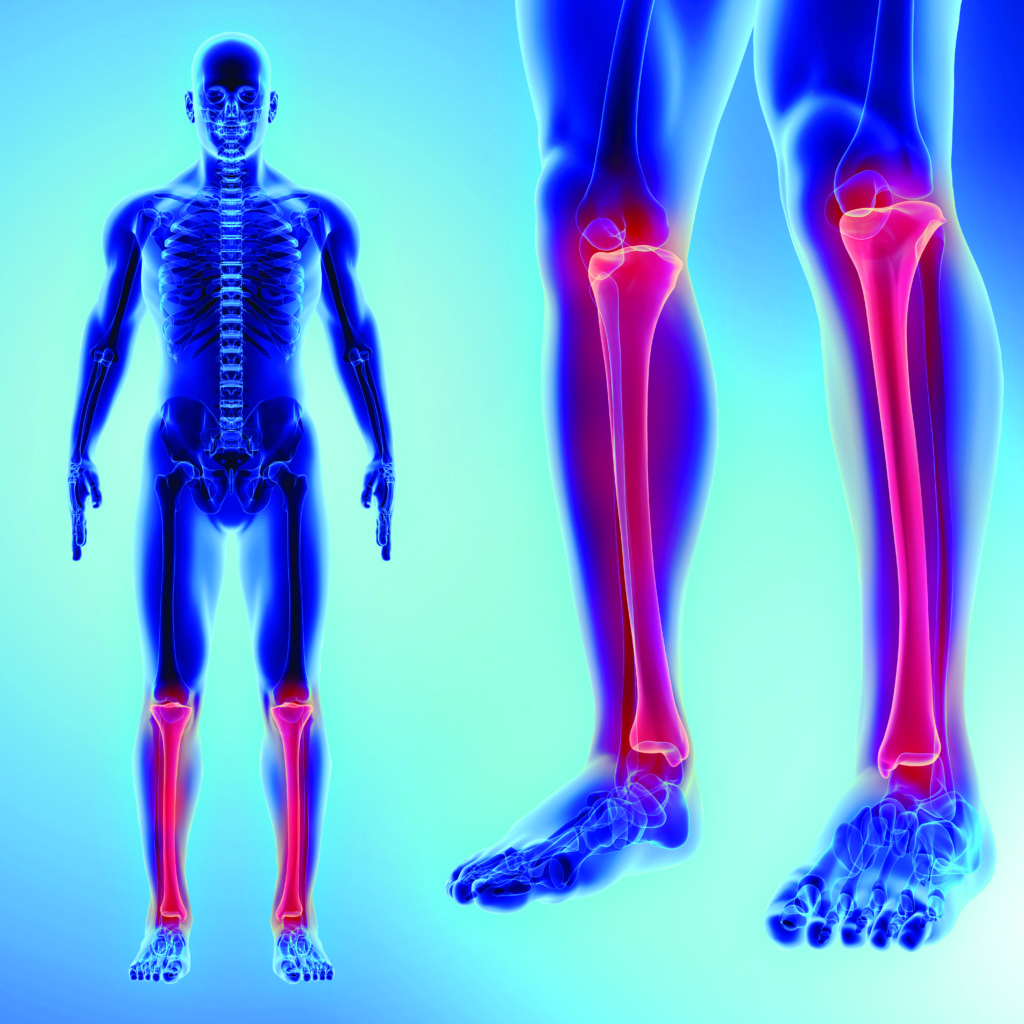 Limb Lengthening Correct Limb Deformity OrthoIndy Blog